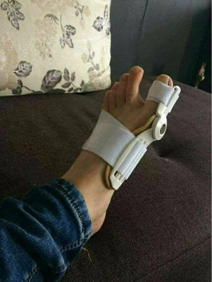جهاز تصحيح عظمة الابهام